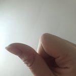 [조언부탁해] <b>엄지</b> 살 줘올라까졋는데 어떻게하지