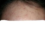 [<b>쪼끔</b>혐주의] 여드름 어떡하냐 진짜 ㅠㅠㅠ