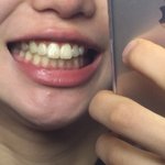 [댓글부탁해] 나보다 <b>이빨</b> 누런 애 있냐