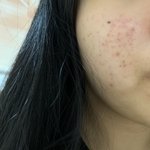 붉은 여드름 <b>흉터</b> 없애는 법 좀 ㅠㅠ 살짝 혐