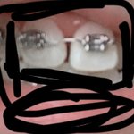 교정하는데 <b>앞니</b>사이에 공간이 생김