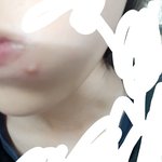 여드름 <b>바늘</b>로 찔러도 돼..?