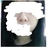 [댓글부탁해] 나 <b>코수술</b> 해야겠지?