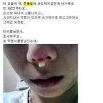 [댓글부탁해] 충격적인 코수술 부작용.jpg