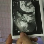 [꼭조언부탁] +추가 (임신21주 5일)의사분들이나 경산모분들 계실까요...