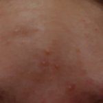 [드루와] 여드름 엄청 많이 나았다는 쓰니야-!