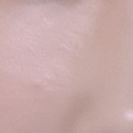 이런 <b>좁쌀</b>여드름 빨리 없애는법 아는 사람