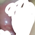 혐주의) 구내염 <b>알보칠</b>이 답이냐..