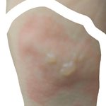 [드루와] ㅣㅇ거대상포진이야 <b>화상</b>이야?
