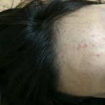 개극혐주의) 여드름 어케 없애