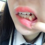 [댓글부탁해] 나 이거 덧니 개심각하지않냐