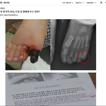 [도와주세요] 수술후 발가락이 이렇게..
