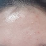 [이것좀봐줘] 이거 내일이면 가라앉을거같음???여드름
