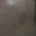 여드름 흉터 어떻게없앰 ㅠ <b>반년</b>째임