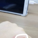 떡볶이 떨어트려서 <b>화상</b>입음