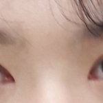 [댓글부탁해] <b>쌍수</b> 재수술 할까말까..?