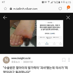 [이것좀봐줘] 수술후 발가락<b>괴사</b>된 아이
