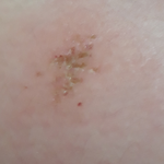 약혐) 개미물린거 긁으니까 손톱자국나고 <b>진물</b>남