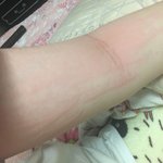 [댓글부탁해] 몸 긁으면 이렇게 붓는 사람 잇어ㅠㅠ?