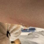 [조언부탁] 제주도 고기집에서 <b>화상</b>을 입었는데 치료비 청구할지 말지...