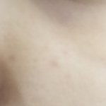 이런 여드름 <b>흉터</b>는 어떻게 없애 ㅜ