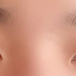 [댓글부탁해] 나 앞트임 하고싶은데