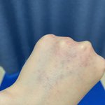 [댓글부탁해] 이거 <b>며칠쯤</b> 지나야 없어져?ㅠㅠ