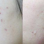 지긋지긋한 여드름피부 벗어난썰 / 엄뉘<b>협찬</b>감사
