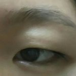 [드루와] 내 <b>눈살</b> 지방제거하면 없어질까..