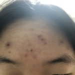 [드루와] 얘들아 나 여드름 <b>박멸</b> 화장품 알아냄