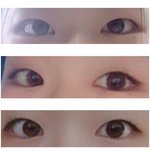 쌍수4개월째후기!!!