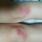 [19] 멍 어떻게 빼ㅠㅠ진짜 급해 <b>큰일</b>났어