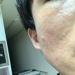 [꼭댓글부탁] 지긋지긋 한 여드름!!!!