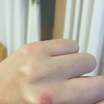 [드루와] 손등에 <b>물집</b>잡힘 ㅋㅋㅋㅋㅋㅋ