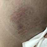 [댓글부탁해] 이 <b>정도</b>면 조퇴를 해야되는가요?(有<b>사진</b>)
