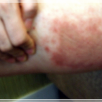 나 사타구니 <b>무좀</b> 걸림