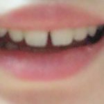 [댓글부탁해] 나 <b>앞니</b>벌어졌는데 어떤지 좀 봐주라