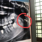 [ㅋㅋㅋㅋㅋ] 내 엑스<b>레이</b> 사진 볼때마다