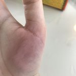 얘들아 이거 <b>화상</b> 입은 거 같은데 엌덯해