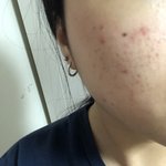 피부 너무 스트레스 받아ㅜ