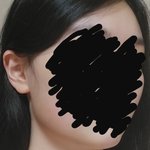 [댓글부탁해] <b>이런턱</b> 보톡스 맞는다vs안맞는다