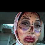위험한 윤곽!<b>양악</b>수술! ㅠ ㅠ 정말 많이 생각하고 하자~
