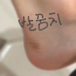 얘들아 나 <b>발꿈치</b>에 이상한 멍 생김