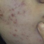 [여드름피부] <b>화농성</b> 여드름