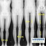 <b>사지</b>연장술 전후래