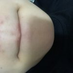 [드루와] 약혐)여드름 흉터 이거 노<b>스카</b>나겔