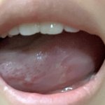 [댓글부탁해] 혀가 너무 아픈데 어떡해 병원 가야 되나 (혐오주의)