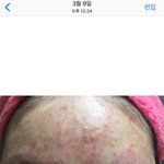 [드루와] 여드름 피부 변천사 (사진주의)