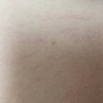[댓글부탁해] <b>허벅지</b> 안 쪽에 튼살 생겼는데 어떻게 없애...?