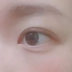 쌍수한 지 5개월<b>가량</b> 됐는데
